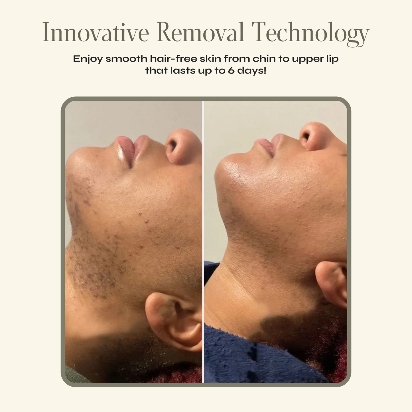 Facial Hair Removal Cream + FREE Calming Serum